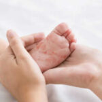 Adult holding babys foot with rash