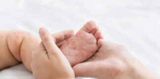 Adult holding babys foot with rash